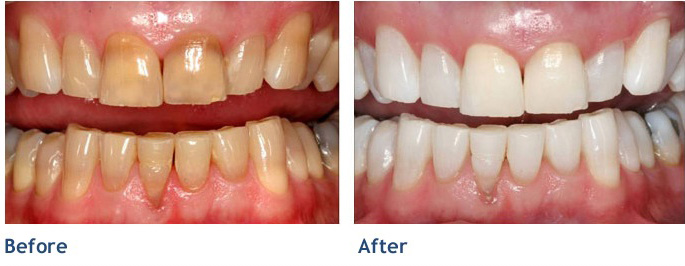 The result of our whitening process, before and after.