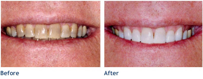 Our Whitening Process offers spectacular results