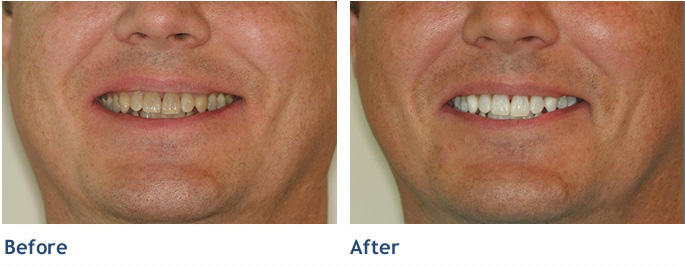 No teeth whitening or bleaching system offers better results