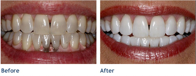 Get back the brilliance you once had with our whitening process