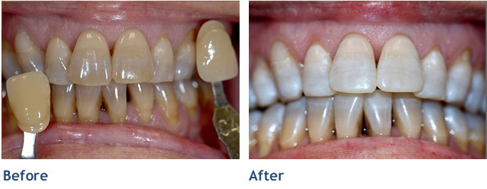 Achieve dramatic improvement in your smile